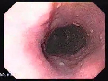 Longstanding gastroesophageal reflux disease (2 of 7)