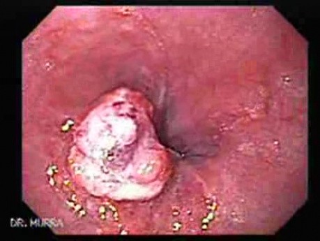 Adenocarcinoma of the Cardia and Fundus with Signet Ring Cells (1 of 5)