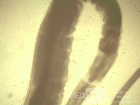 Colonoscopy observing a trichuris in the cecum (7 of 8)