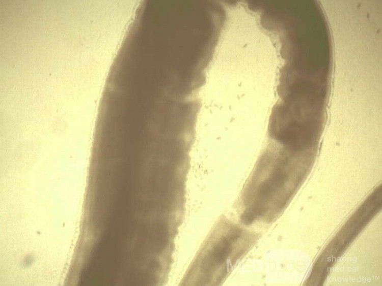 Colonoscopy observing a trichuris in the cecum (7 of 8)