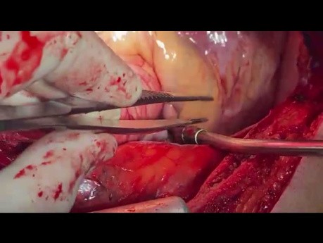 Patient RCA Aneurysm and Three Vessels Disease Involvement Undergone CABG and RCA Resection
