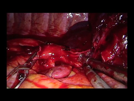 Complex Uniportal VATS Left Upper Sleeve Reconstruction after Chemoradiation
