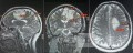 Surgical Planning with Neuronavigator in Patient with Intracranial Mass Lesion. High Grade Glioma.
