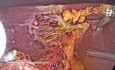 Incidental Intraabdominal Loose Body Discovered During Laparoscopic Cholecystectomy