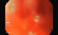 What is the Standard of Care of Bleeding Cardia Lesion