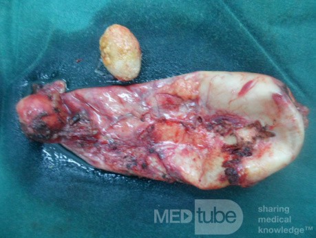 Acute cholecystitis removed by Lap chole