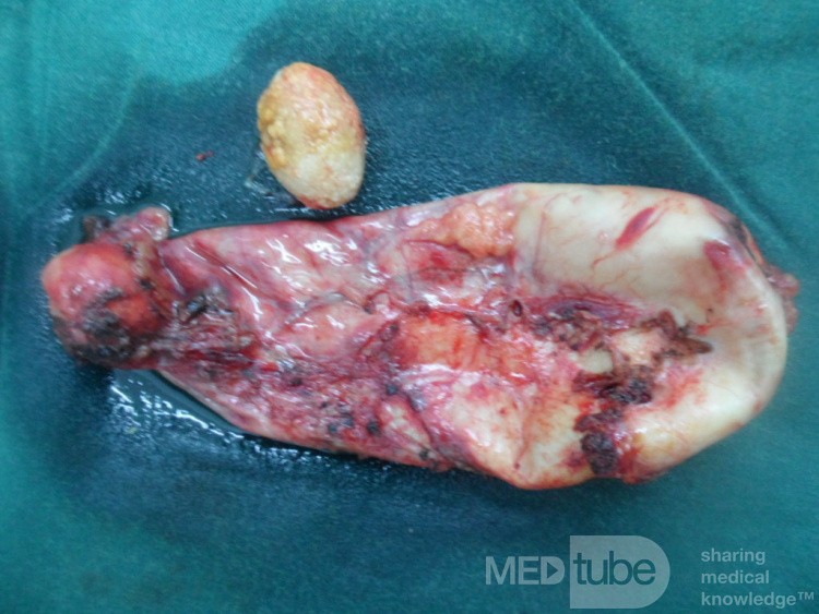 Acute cholecystitis removed by Lap chole