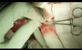 Appendectomy Open Technique