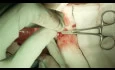 Appendectomy Open Technique