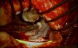Redo Mitral Valve Repair