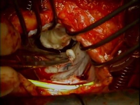 Redo Mitral Valve Repair