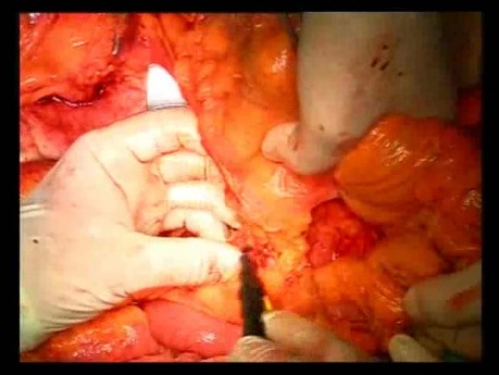 Open Right Hemicolectomy – Technical Principles - Operation No 2 - Part 3