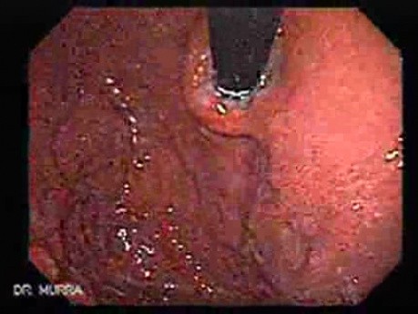 Klatskin´s Tumor - Assessment of the Gastric Ulcer