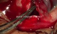 Pole to Pole Surgery