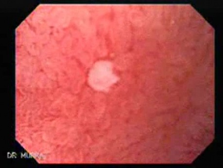 Microerosion of the Duodenal Bulb