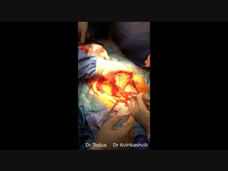 Total Exenteration with Perineal VRAM Flap for Recurrent Vulvar Cancer
