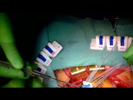 How is a Conventional (Sutured) Aortic Valve Implanted at Aortic Valve Replacement Surgery