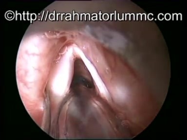 Adductor Vocal Fold Palsy - Treatment