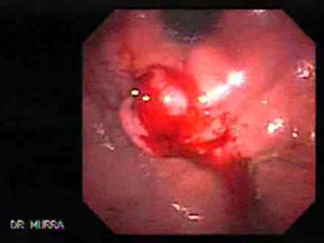 Upper Gastrointestinal Tract - Bleeding (3 of 7)