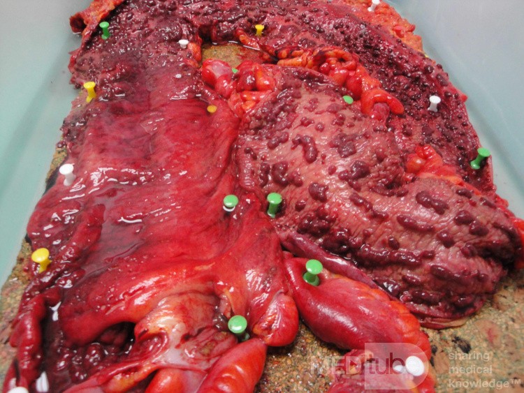 Multiple Rectal Ulcers (98 of 110)