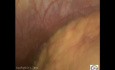 CO2 Bubbles Injected  During Veress Needle  Insertion