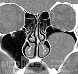 Huge Max Cyst