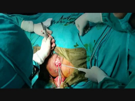 Utero Cervico Secropexy with Prolene Mess
