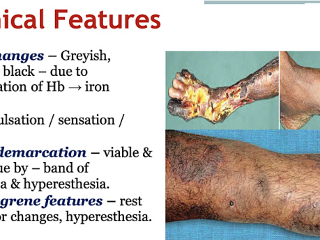 Gangrene & Diabetic Foot