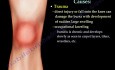 Knee Bursitis Causes - Video Lecture