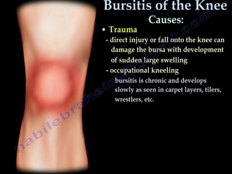 Knee Bursitis Causes - Video Lecture
