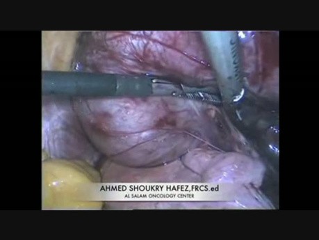 Laparoscopic Resection of Broad Ligament Myoma