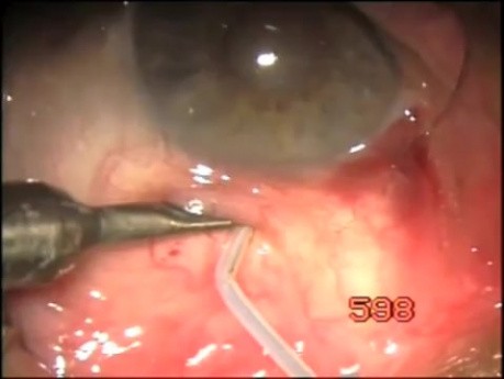 TCTCF filtration technique