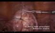 Ambulatory laparoscopic polymyomectomy