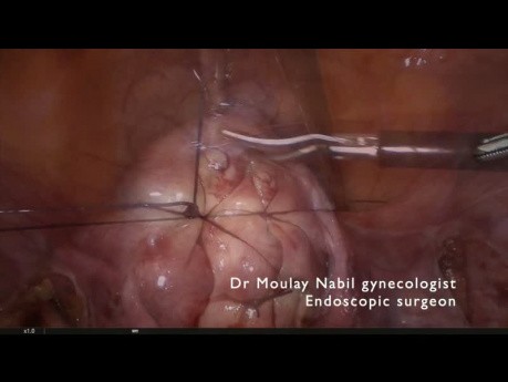 Ambulatory laparoscopic polymyomectomy