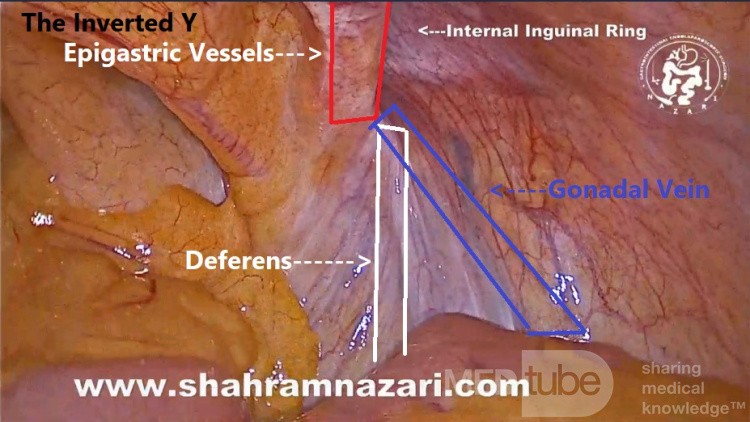 Inverted Y