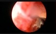Right Percutaneus Nephrolithotomy
