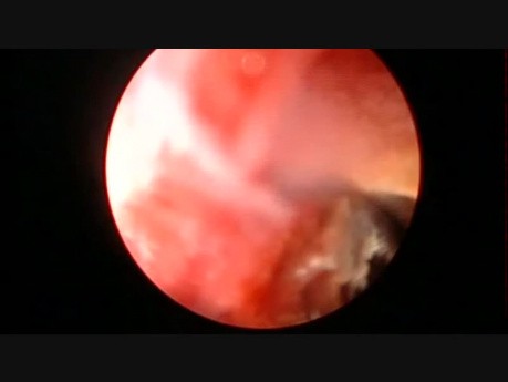 Right Percutaneus Nephrolithotomy