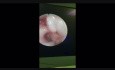 CO2 Laser Supraglotoplasty