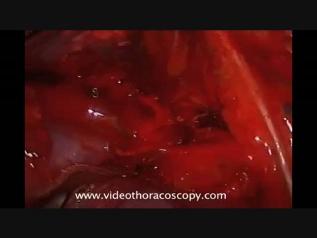 Non Intubated Right Upper Lobectomy by Means of Single Port VATS