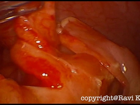 Mucocele Appendix - Lap Appendectomy