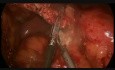 Laparoscopy in Mesenteric Occlusion 1