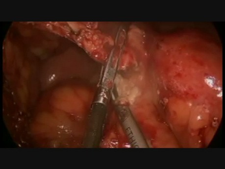 Laparoscopy in Mesenteric Occlusion 1