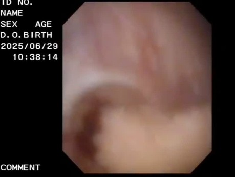 Divertículo vesical con neoformación.