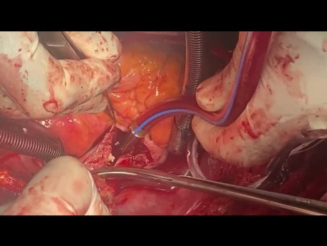 Patient with RA Mass and Invasion to RV Undergone Resection and Reconstruction with Pericardial Patch