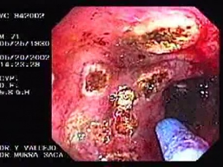 Radiation Proctosigmoiditis (12 of 14)