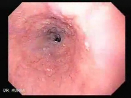 Esophageal Varices and Hiatus Hernia (3 of 3 )