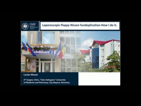Laparoscopic Floppy Nissen Fundoplication: How I Do It