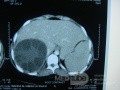 Liver hydatid cyst - Abdominal CT