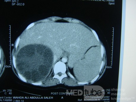Liver hydatid cyst - Abdominal CT