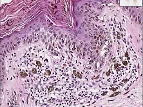 Lentiginous junctional nevus, hypermela